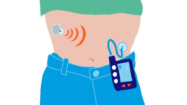 An illustration of a closed loop system, showing an insulin pump connected to a CGM