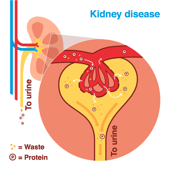 Diabetic nephropathy (kidney disease) infographic showing abnormal amounts of protein are leaving the body through the urine. This is an early sign of kidney disease. 